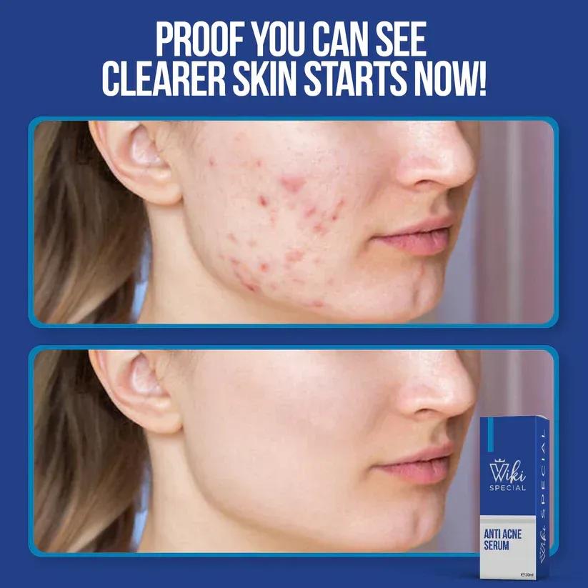 Wiki Anti-Acne Serum 30ml Brightening Hydrating