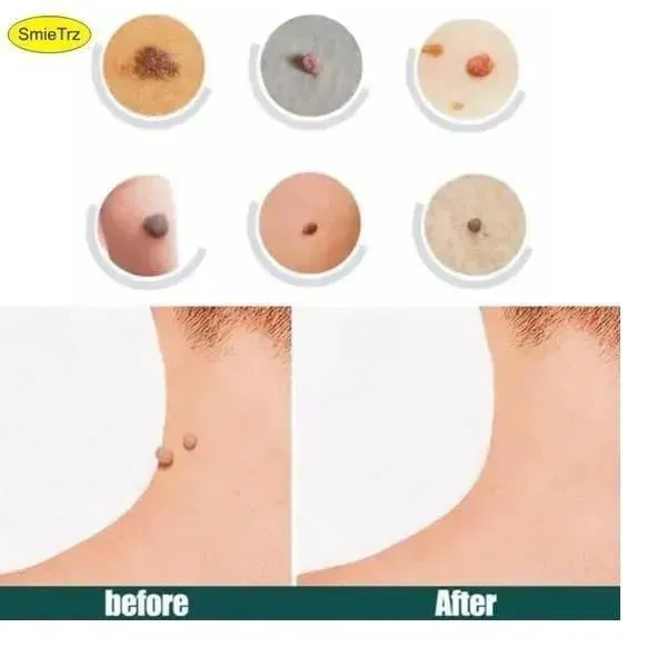 DermaSmooth Skin Tag Remover Patch White 40pcs